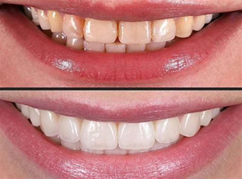 Dental Veneers Delhi India Cost of Dental Veneers Delhi India