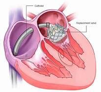 What Is A Bioprosthetic Valve