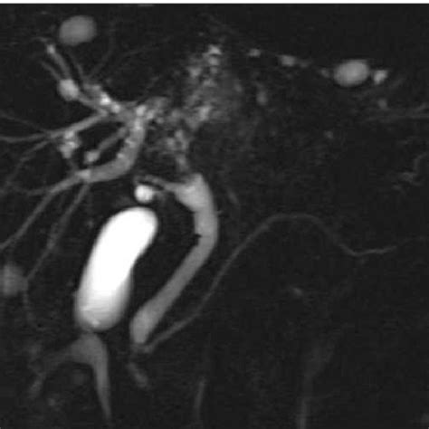 Mrcp Image Obstruction Of The Hilar Bile Duct Due To Filling Defect Is