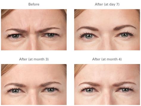 BOTOX Frown Lines - Before and After Galleries, Long Beach