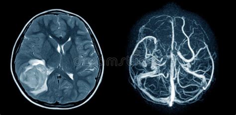 Magnetic Resonance Imaging Of The Brain And Mra With Mrv Of The Brain