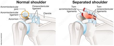 Acromioclavicular joint separation or AC joint separation or shoulder ...