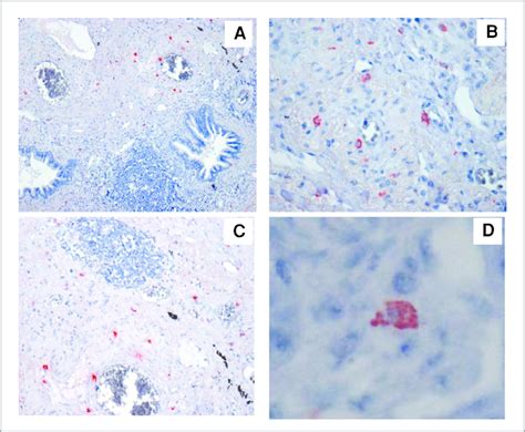 NK cells are present in lung tumor microenvironment. The presence of NK... | Download Scientific ...