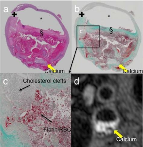 This Histology Figure Confirms The Presence Of Intra Plaque Haemorrhage