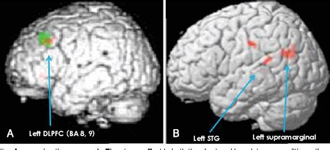 Dorsolateral Prefrontal Cortex