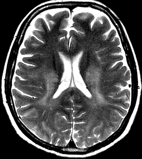 Adult Leukodystrophies A Step By Step Diagnostic Approach RadioGraphics