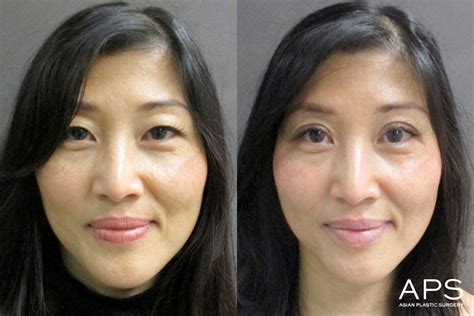 Eyelid Surgery Before And After Photos For Asian Patients