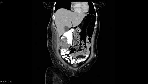 Bowel Carcinoma Presenting With An Abdominal Wall Abscess Eurorad