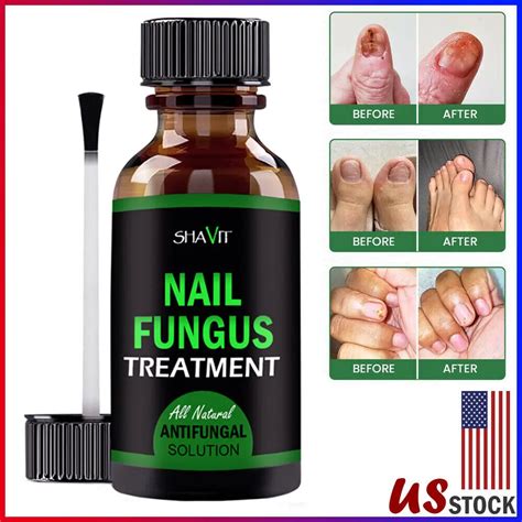 Toenail And Fingernail Fungus Treatment Extra Strength Antifungal ...