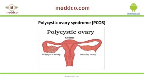 Ppt Polycystic Ovary Syndrome Pcos Causes Symptoms Diagnosis And Treatment Powerpoint