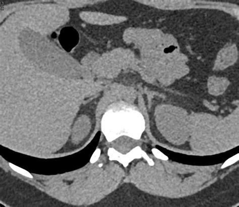 Normal Adrenal Glands Adrenal Case Studies Ctisus Ct Scanning