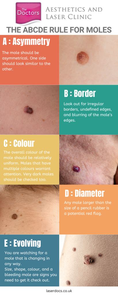 Mole Health Check The Abcde Guide Doctors Laser Clinic