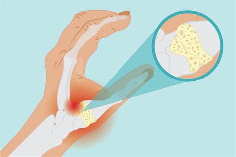 Basal Joint Arthritis Symptoms and Treatment