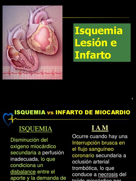 Isquemia Lesion E Infarto Pdf Electrocardiografia Infarto De Miocardio