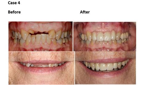 Cosmetic Dentistry Before and After - Sydney Cosmetic Specialists