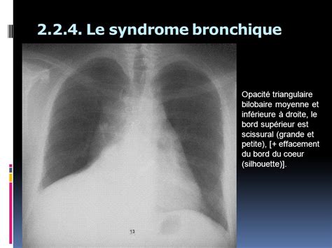 Visiteur Jupon Ligne Du Site Syndrome Bronchique Radio Thorax