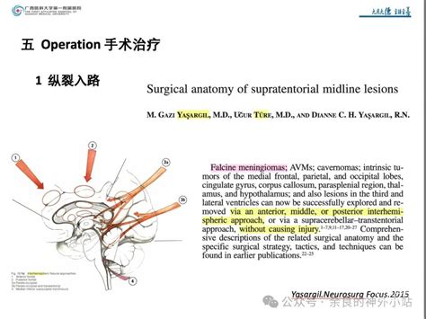 纵裂入路及镰旁脑膜瘤的手术治疗 脑医汇 神外资讯 神介资讯