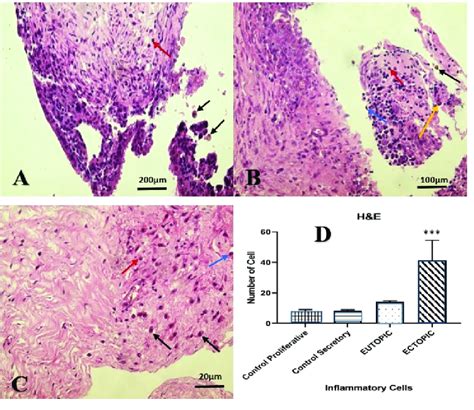 A Microscopic View Of The Endometrium In The Ectopic Group With