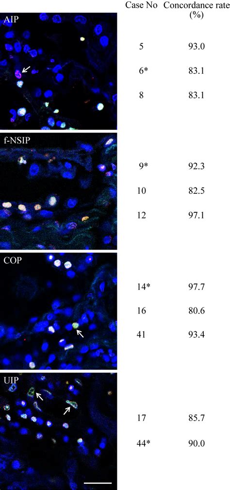 Increased Ectodomain Shedding Of Cell Adhesion Molecule As A Cause Of