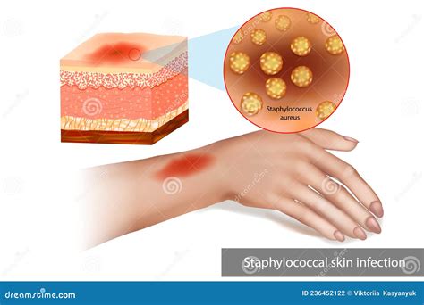 Cellulitis Infection