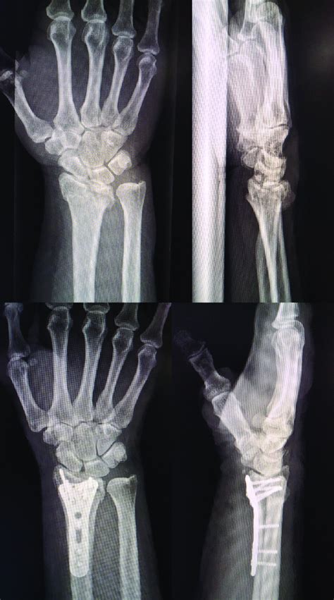 Preoperative Radiographs Were Obtained To Facilitate Surgical Planning