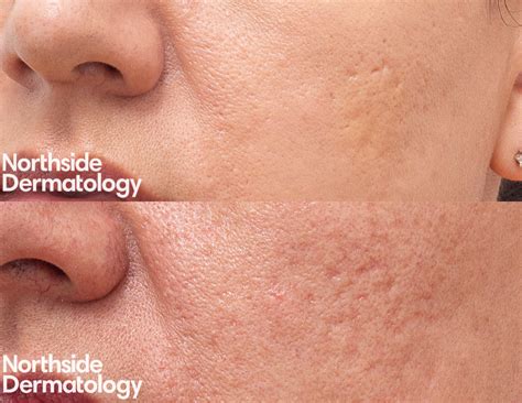 Acne Scar Treatment Melbourne Northside Dermatology