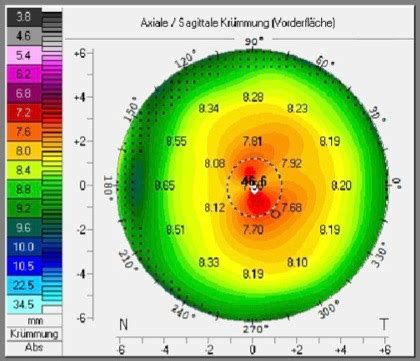 Hornhauttopografie Augenarzt München MVZ Prof Neuhann München