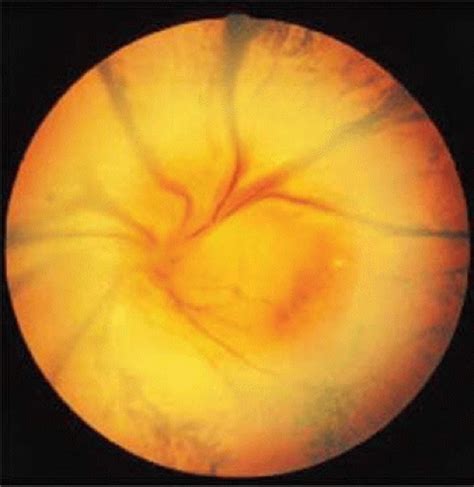 Infectious Retinitis Ento Key