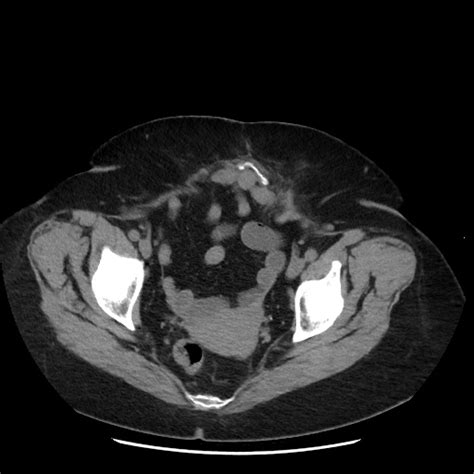 File Distal Colocolic Intussusception Due To Lipoma Epiploic