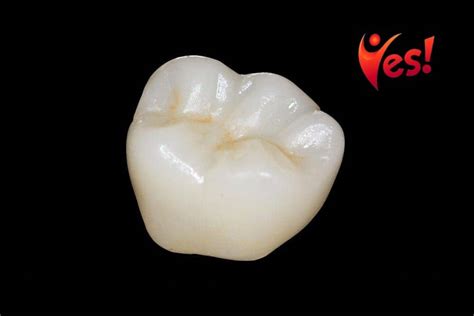 What Is A Zirconia Crown Yes Dental Care