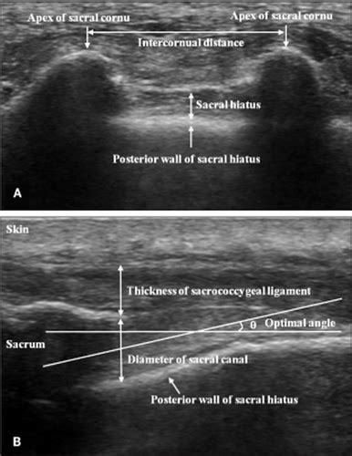 Anatomic Differences In The Sacral Hiatus During Caudal Epidural