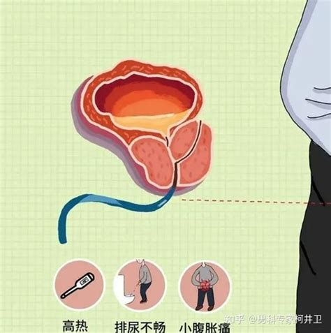 前列腺炎的诊断步骤都包括哪些？ 知乎