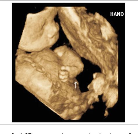 Figure From Prenatal Sonographic Detection Of Multiple Congenital