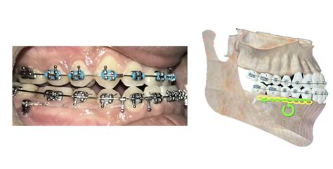 Orthodontics In Review Paper Review A Re Look At Class Iii Camouflage Orthodontics In Summary