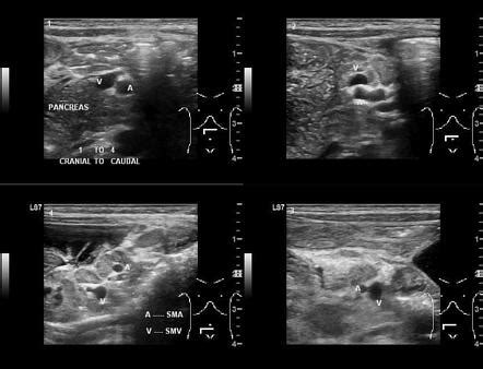 Midgut volvulus with a mesenteric cyst | Radiology Case | Radiopaedia.org