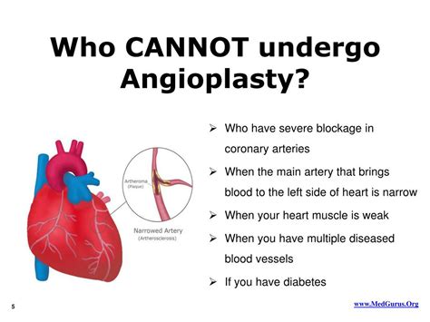 Ppt Facts On Angioplasty Powerpoint Presentation Free Download Id