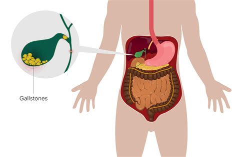 Precautions To Be Taken Before Gallbladder Surgery GBL Hospital