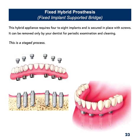 Patient's Guide to Dental Implants - ATHENS DENTAL IMPLANT CENTER
