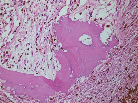 Head And Neck Primary Oral Mucosal Melanoma