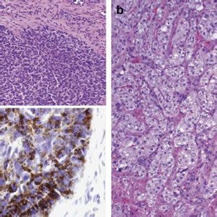 Hematoxylin And Eosin Stains With Insets Showing Adipophilin