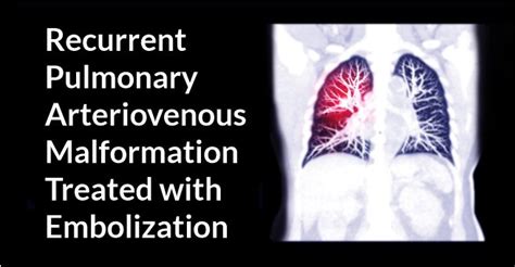 Recurrent Pulmonary Arteriovenous Malformation Treated With Embolization