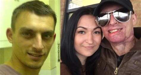 Daniel Was Savagely Doused In Acid By His Exil Exbut Then Found Love