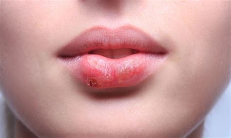 S Ntesis De Art Culos Como Curar Un Herpes Labial Actualizado