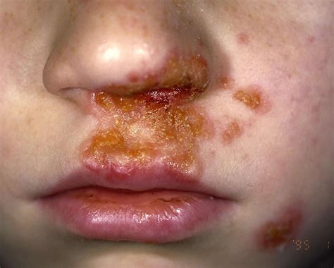 Impetigo Contagious Skin Infection Causes Treatment Prevention Hot