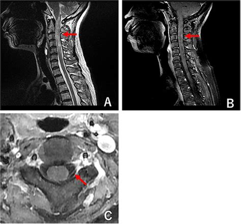 Ramsay Hunt Syndrome Mri