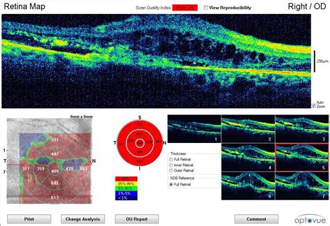 Blog Choroidal Neovascular Membrane Prime Retina Eye Care Centre