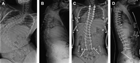 The Role of Gait Analysis in Treating Gait Abnormalities in Cerebral ...