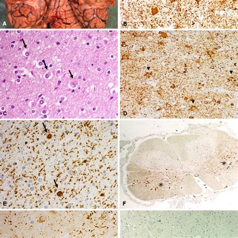 Neuropathological Findings A Macroscopic View Of Fresh Specimen