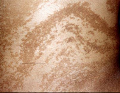 Hypomelanosis Of Ito Syndrome Typical Blaschko S Lines Program