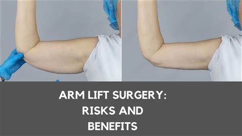 PPT - ARM LIFT SURGERY RISKS AND BENEFITS PowerPoint Presentation, free ...